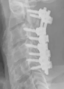 Artrodeses Posteriro