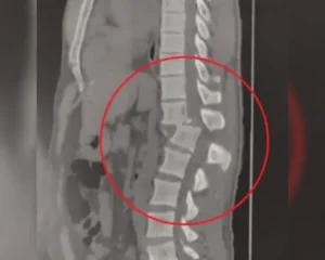 traumatismo_raquimedular_trm_01