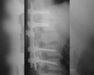 traumatismo_raquimedular_trm_02