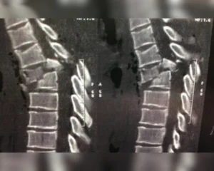 traumatismo_raquimedular_trm_03