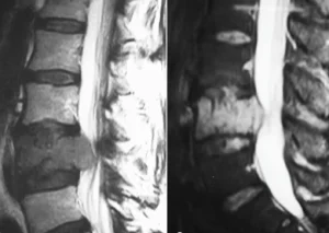 tumores_coluna_vertebral_02