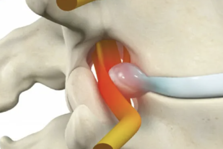 HerniaDeDisco01